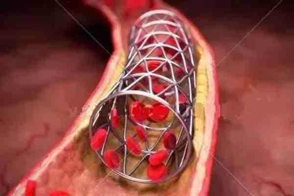 冠脉支架进入“千元时代”-冠脉支架多少钱一个-第3张图片