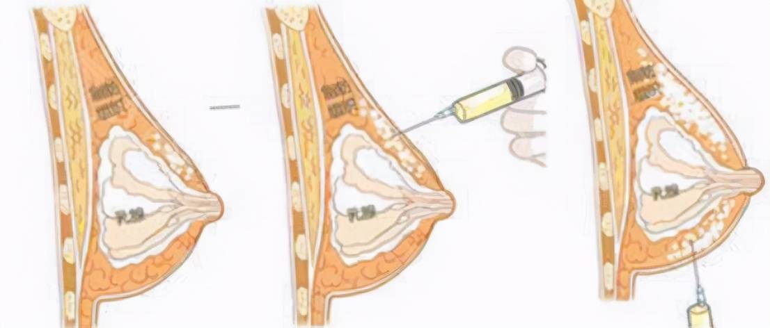 自体脂肪活细胞隆胸?（自体脂肪隆胸是怎么做的？）-第3张图片