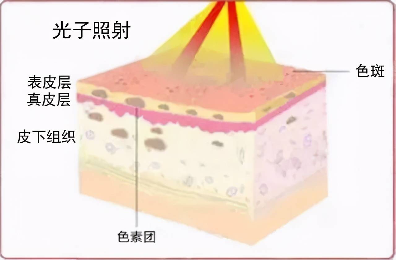 光子嫩肤能维持多久(光子嫩肤会有依赖性吗)-第6张图片