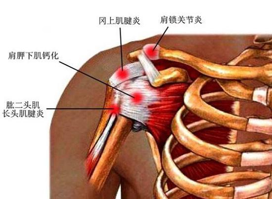 肩周炎三个动作自愈方法（患了肩周炎真的不好受）-第1张图片