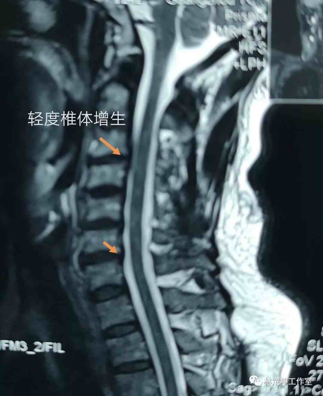 颈椎病引起的头晕恶心怎么办（颈椎引起的头晕怎么办）-第4张图片