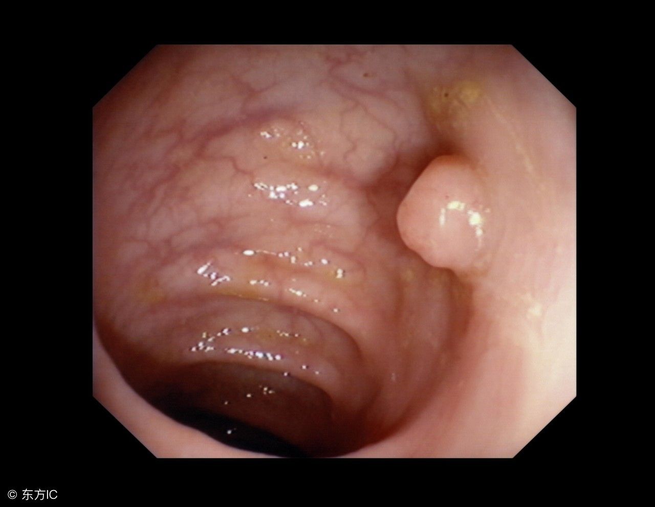 大肠息肉的治疗方法（治疗大肠息肉，无非就这几个方法）-第1张图片