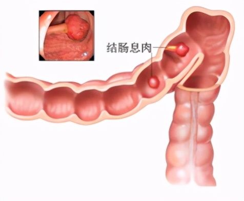 大肠息肉？（什么是大肠息肉？）-第1张图片