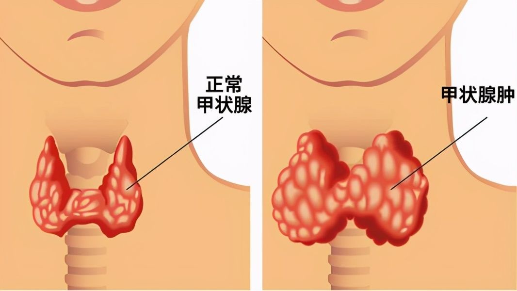 甲亢最好的治疗方法（甲亢的症状有哪些？）-第1张图片