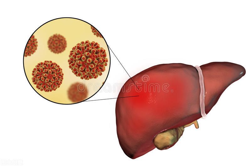 得了肝病有什么症状？（肝脏的症状表现多种多样）-第1张图片