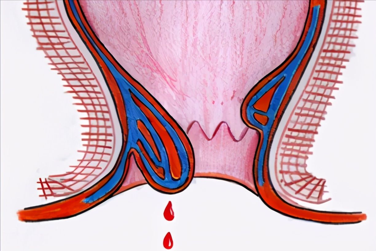 拉血是为什么?（大便拉血是怎么回事？）-第4张图片