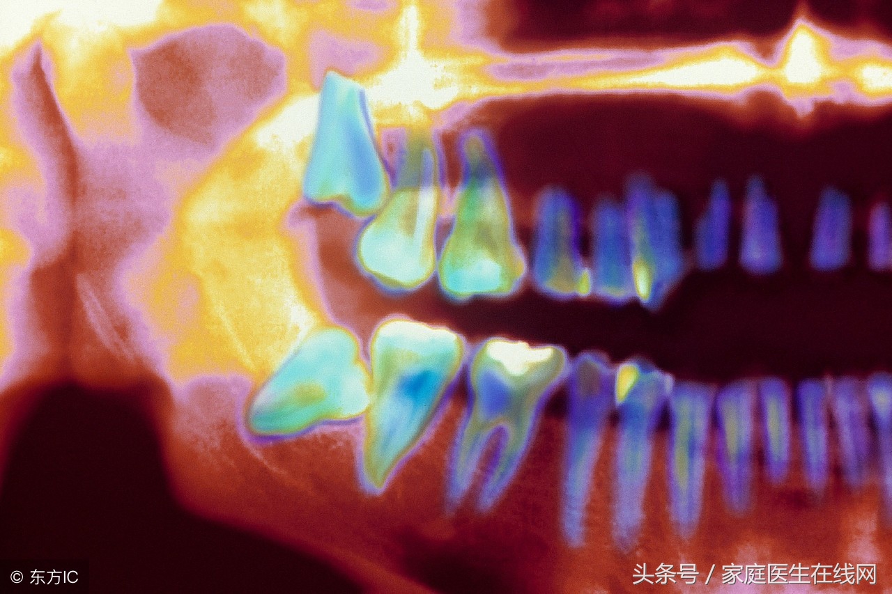 每个人都有智齿吗(为什么有些人会长智齿，长智齿会有什么影响)-第4张图片
