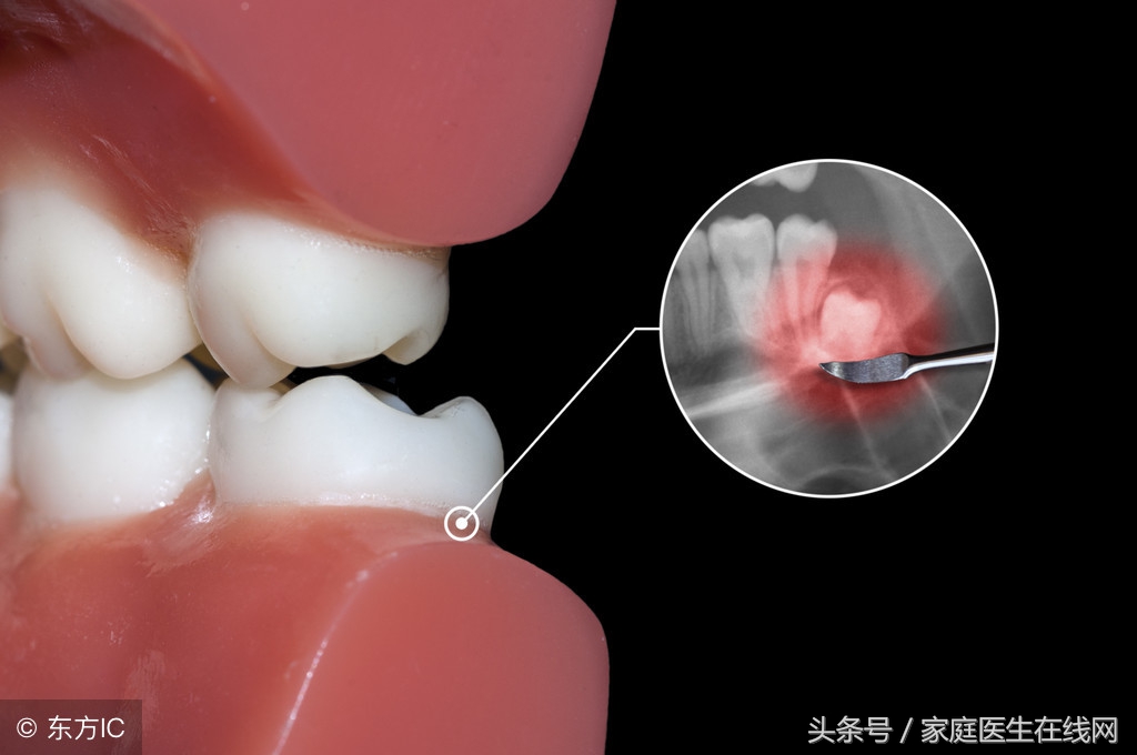 每个人都有智齿吗(为什么有些人会长智齿，长智齿会有什么影响)-第3张图片